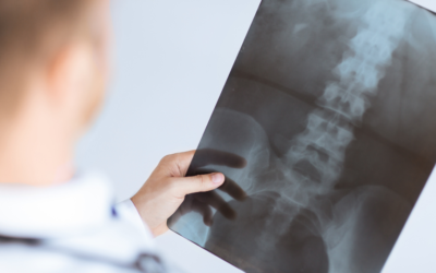 Can Spinal Stenosis Be Helped? | Physicians’ Guide for Spine Care