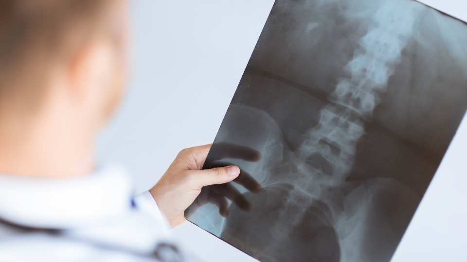 spinal stenosis x-ray