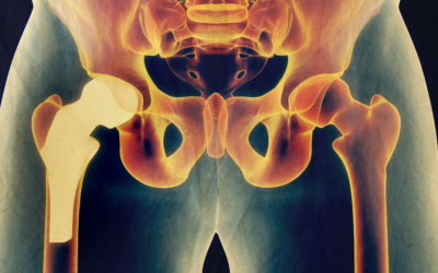 What Are Hip Replacement Precautions for Life? | Hip Replacement Surgery | Joint Surgeries